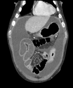 Encapsulating Peritoneal Sclerosis | Kidney