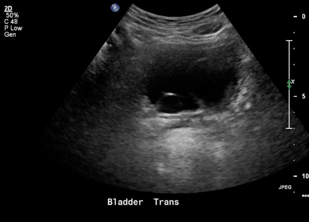 IF WiW Bilateral Hydroceles | Kidney